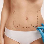 Abdominoplasty