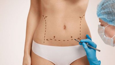 Abdominoplasty