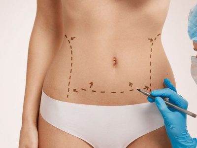 Abdominoplasty