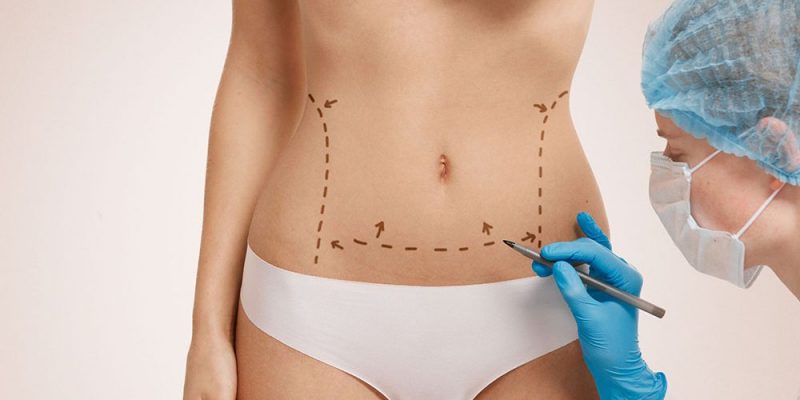 Abdominoplasty